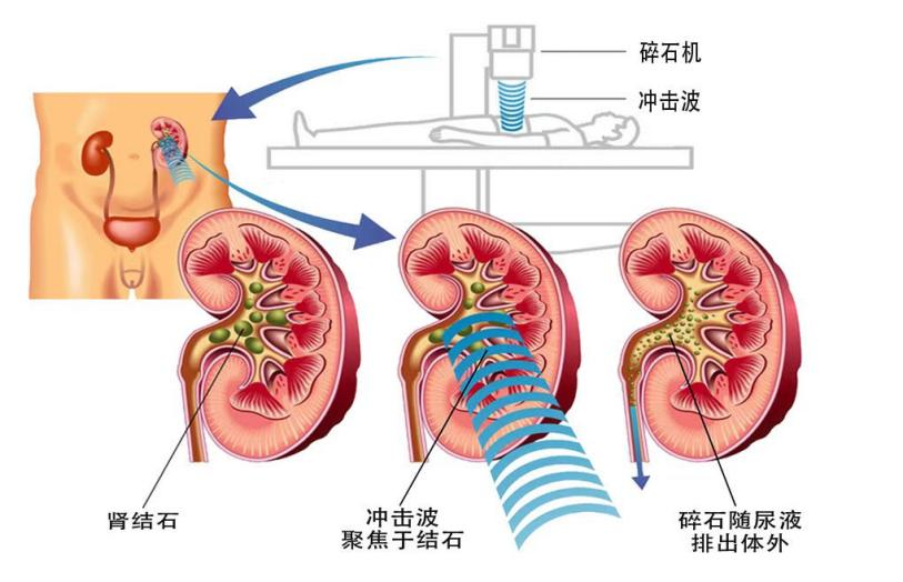 How to treat stones，如何治疗结石