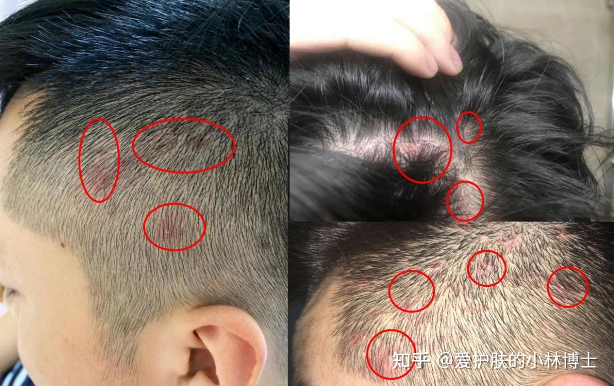 男生头皮不停地长红色小疙瘩,抠了还有血痂,到底怎么彻底解决? - 知乎
