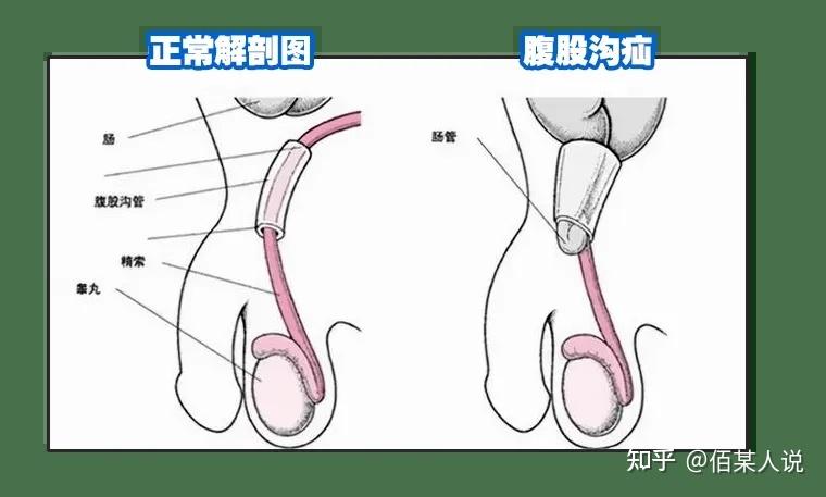 带你正确认识腹股沟疝