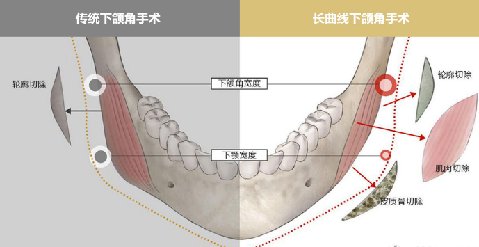 怎么拥有清晰的下颌角 v2-d528782c0b8cf2655e96811dbc33ec5d_1440w.jpg?source=172ae18b