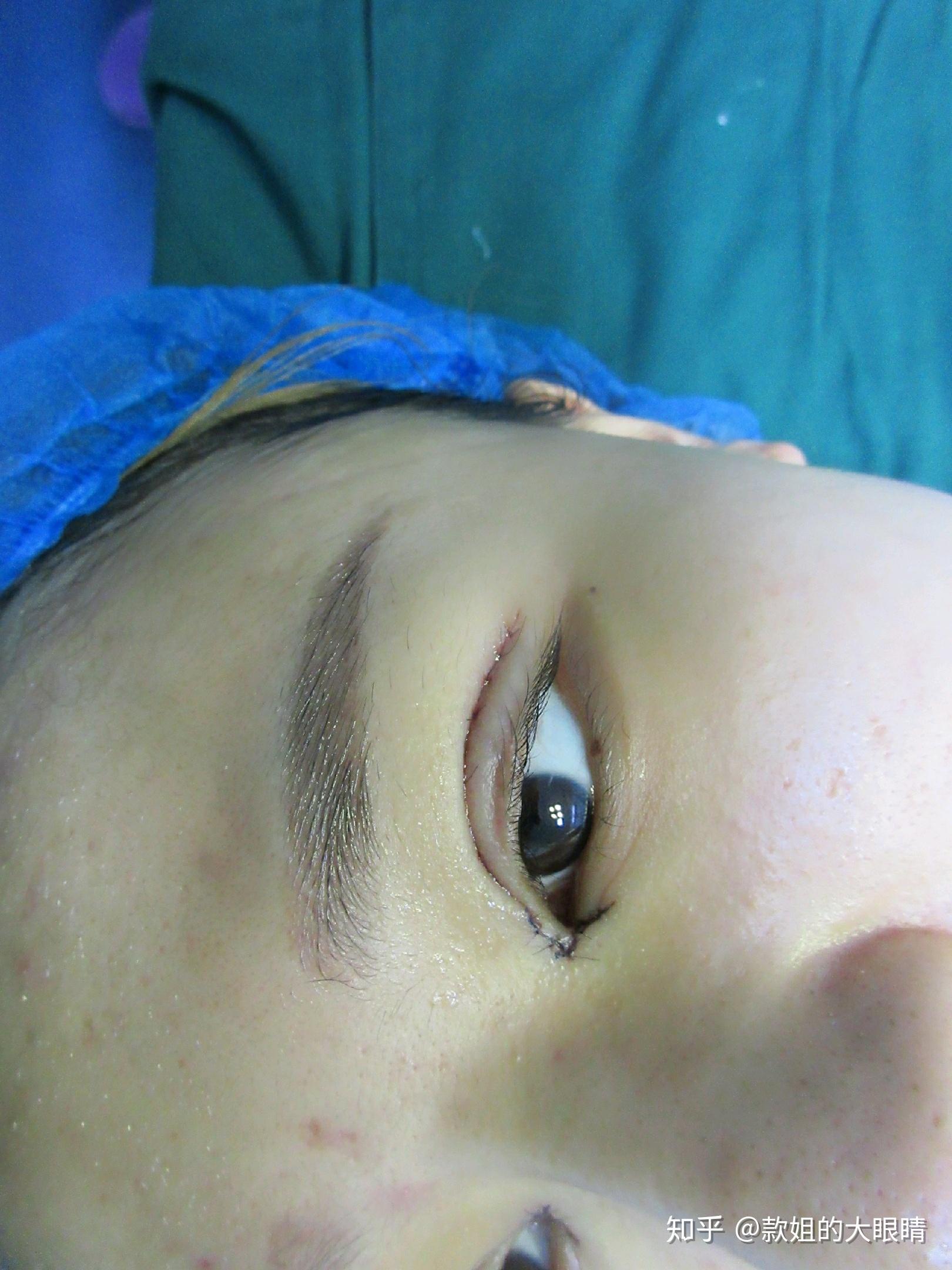 手术所以我这次就想直接做个永久性的双眼皮所以埋线双眼皮一定是要眼