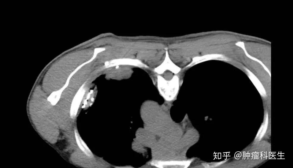 胸腺瘤复发转移碘125粒子植入治疗技术再获新突破