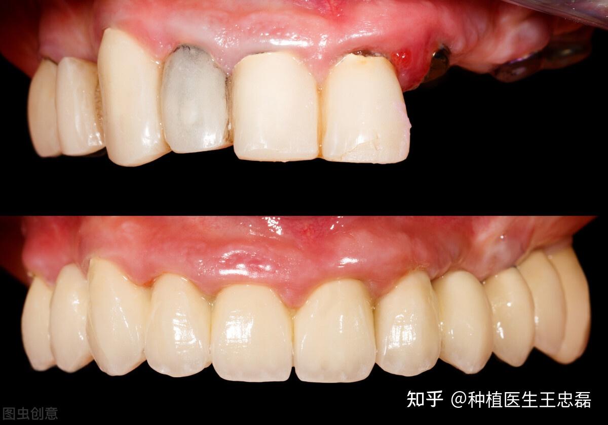 卢君峰：前牙重度磨耗的临时修复-北京瑞皓医疗科技有限公司