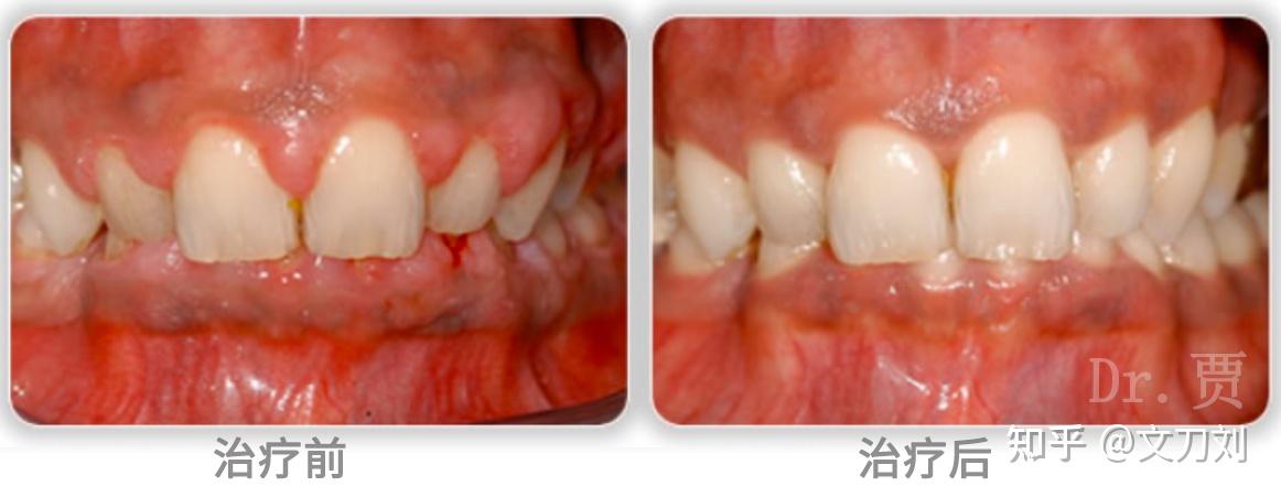 牙医使用特殊的牙周器械,对患者牙周组织进行清洁,其目的是去除牙周袋