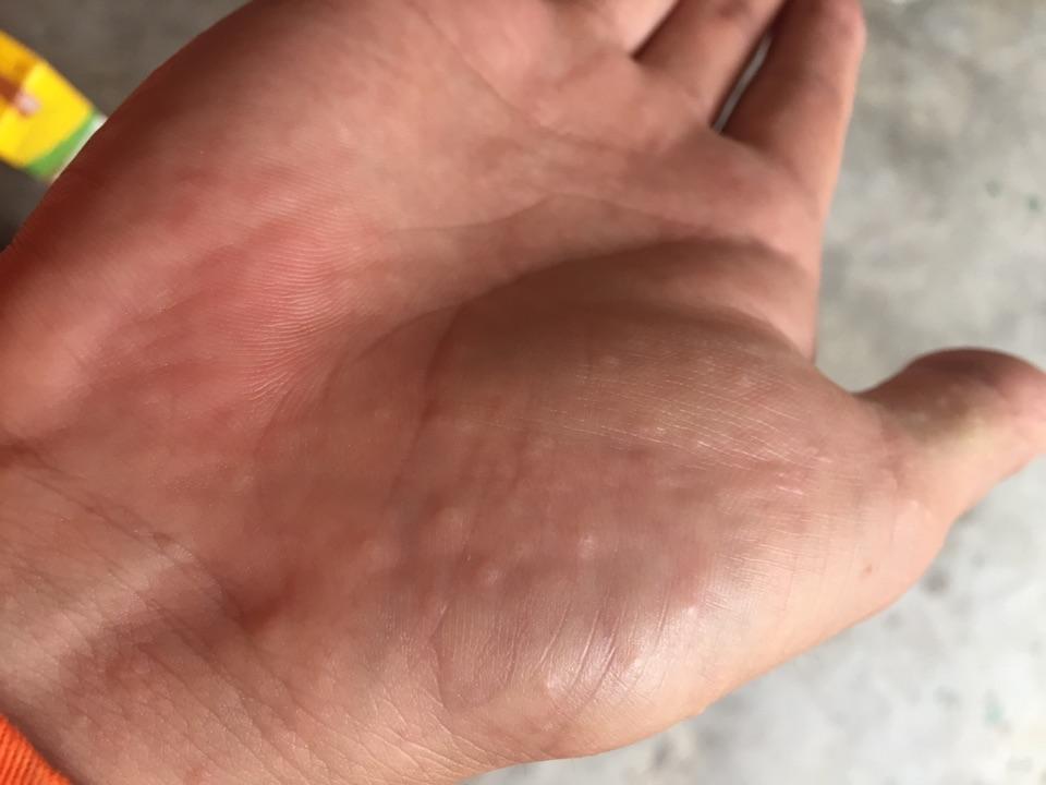 手上突然长了好多小水泡,不痛也不痒,除了手背其他地方都有,不过密集