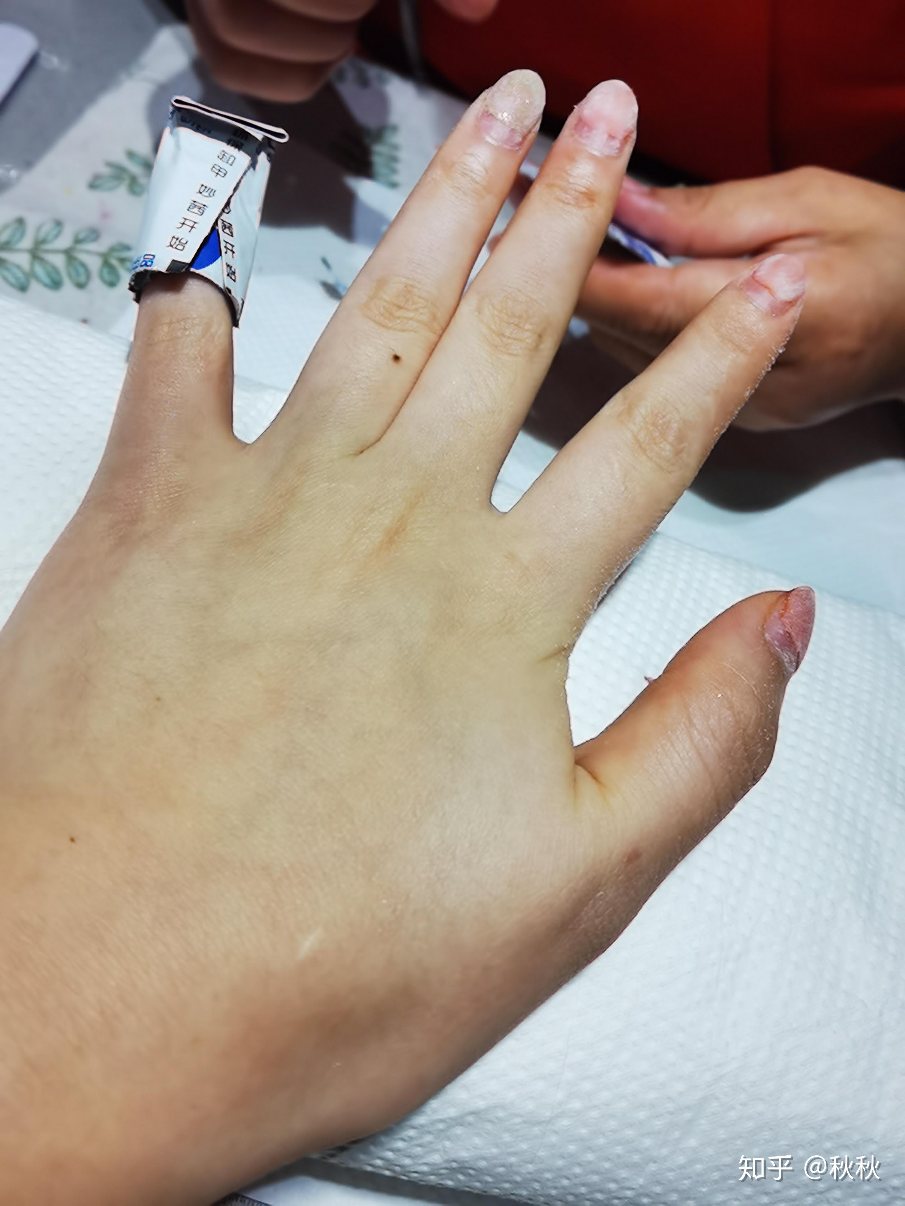 正确面对抑郁症的第103天