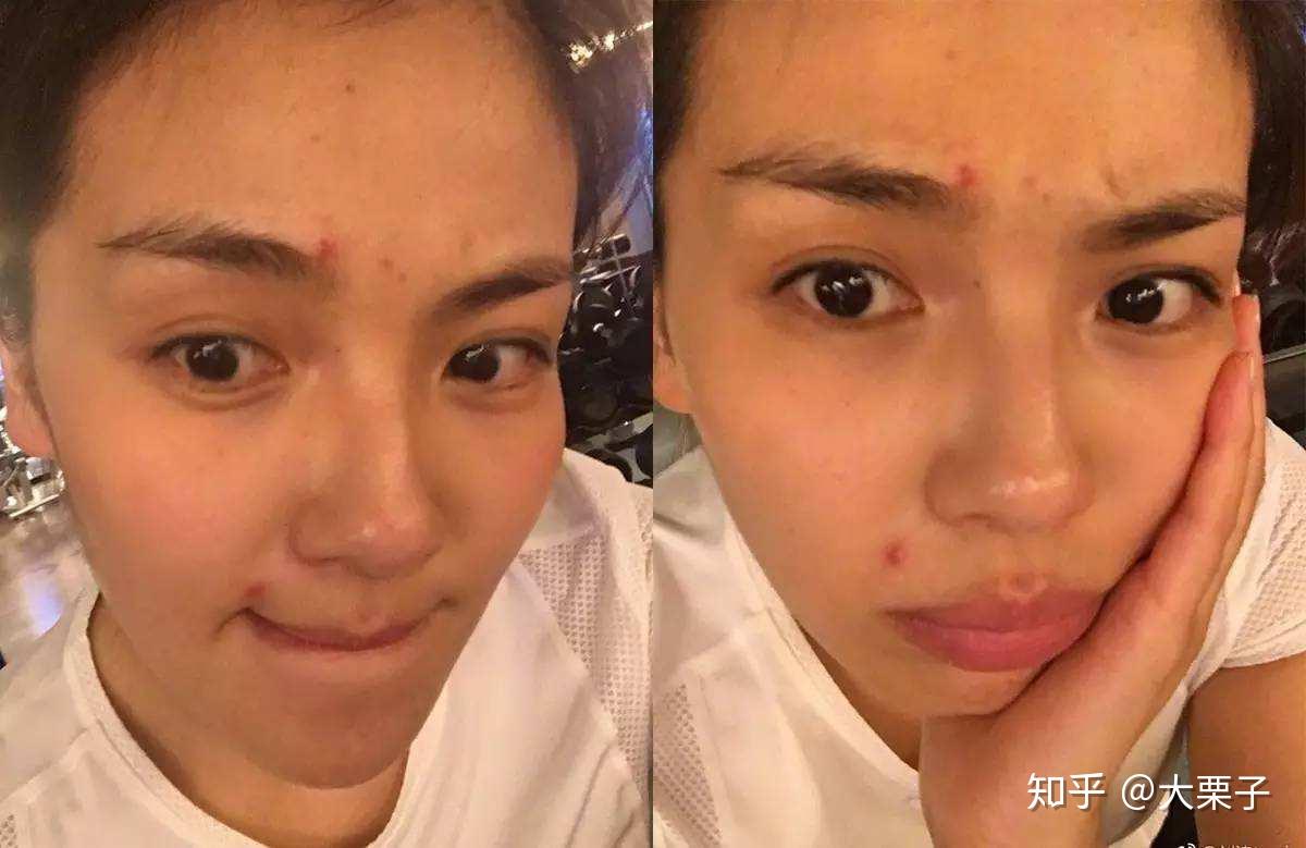 不仅普通人会遇到肌肤问题,就连很多明星皮肤问题也很"严重",吴昕曾经