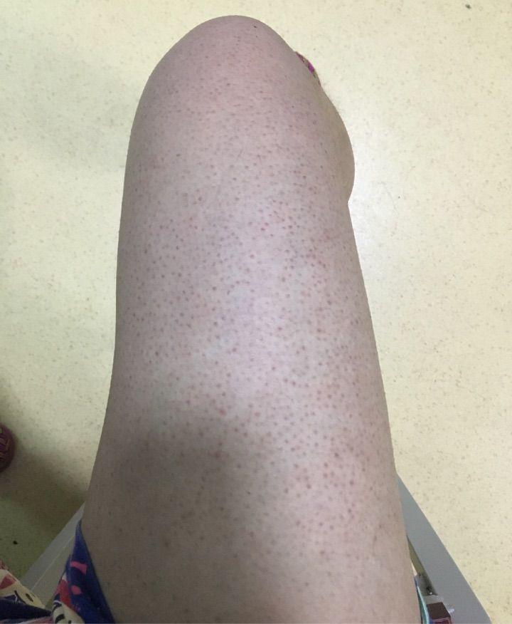 怎么淡化鸡皮疙瘩红点点(皮肤有鸡皮疙瘩那种小点点怎么办)