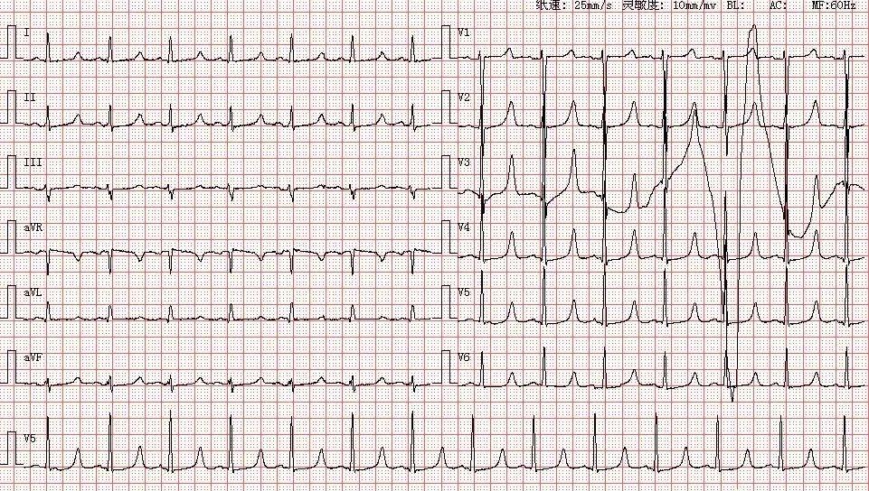 心电图图库丨u波异常直立倒置
