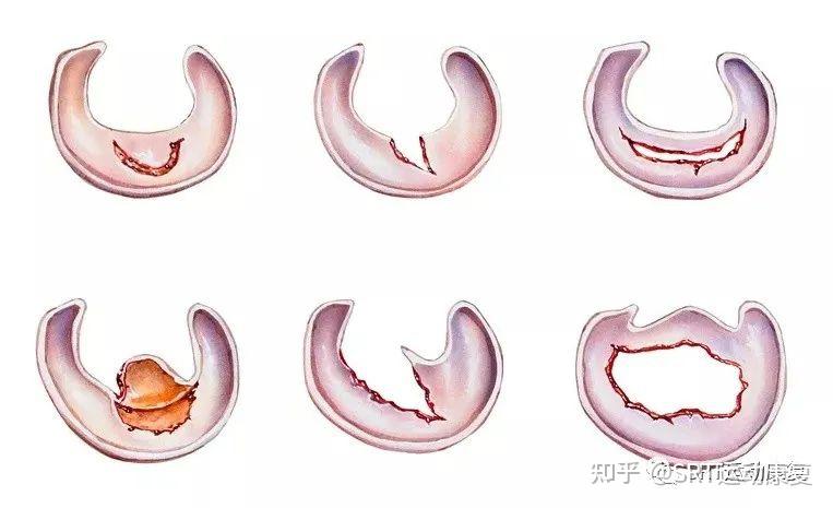 74那很多人說半月板這種損傷是不是隻會出現在劇烈運動的運動員