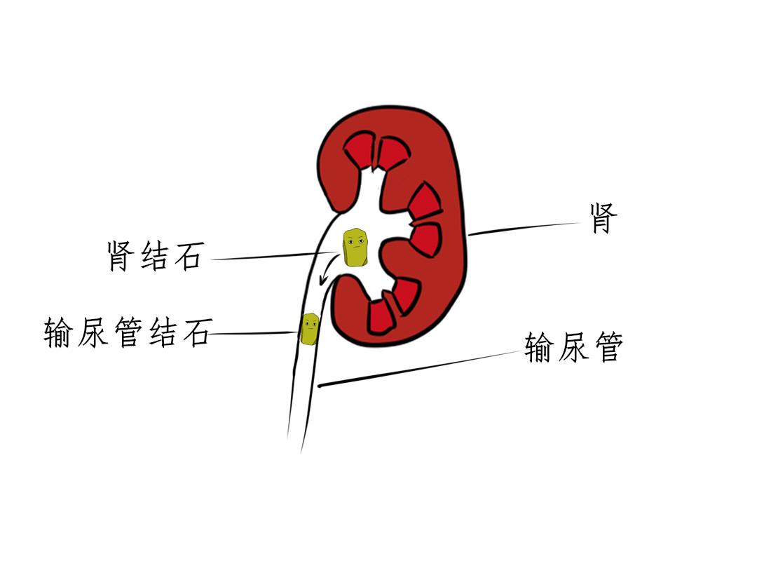 输尿管膀胱吻合术-泌尿外科手术-医学