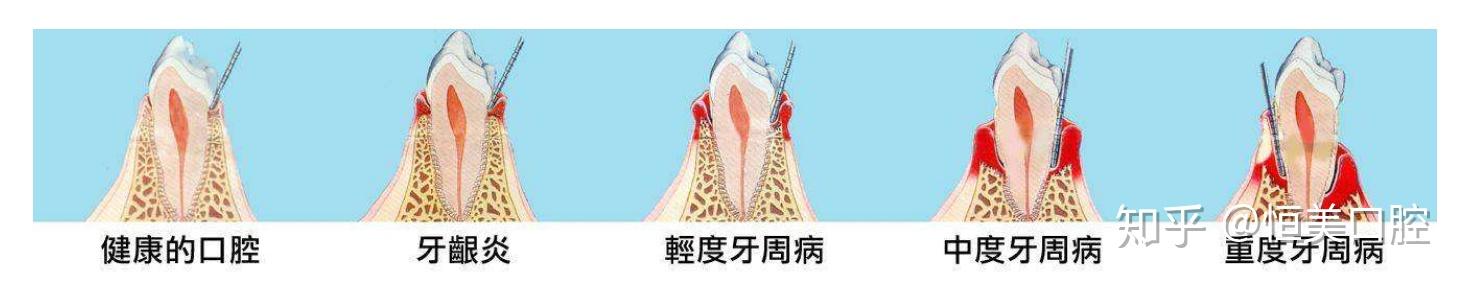 科普：牙周炎（牙周病）你需要知道的都在这！ - 知乎