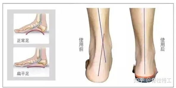 就像推翻了多米诺骨牌一样,还可能往上影响到膝盖,骨盆,脊柱等部位