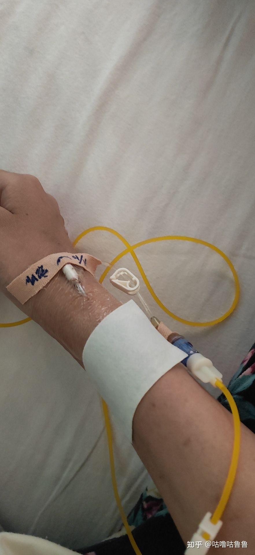 手臂上都是留置针的痕迹