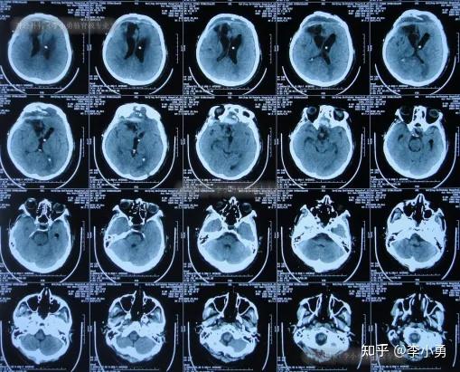 美国纽约大学医院脑垂体瘤切除术后脑脊液漏4次修补术后再脑积水脑