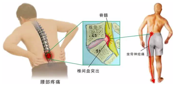 明明是腰椎间盘突出 为什么会腿疼 知乎 明明是腰椎间盘突出 为什么会腿疼 知乎