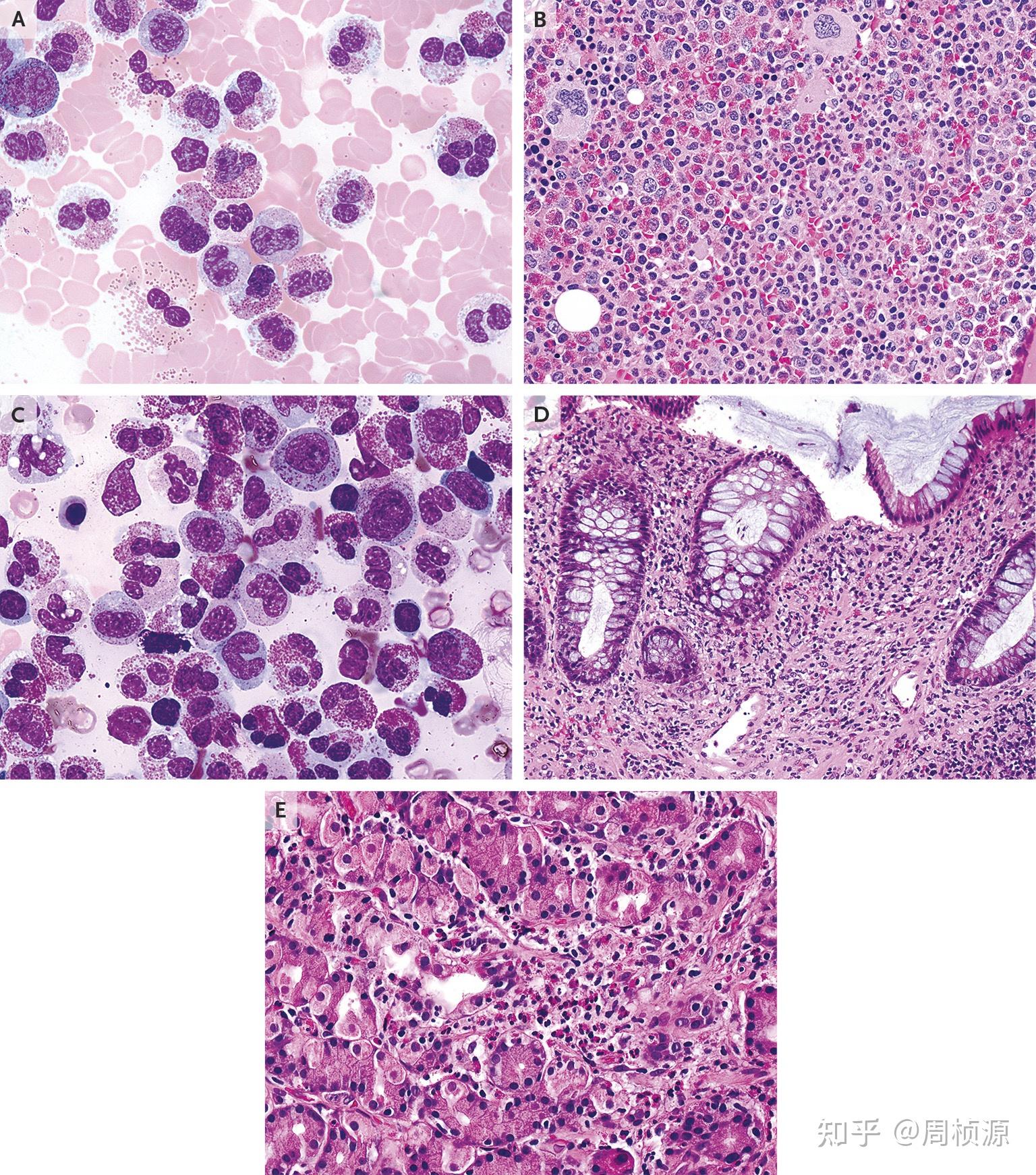 peripheral-blood smear and biopsy specimens of bone marrow and