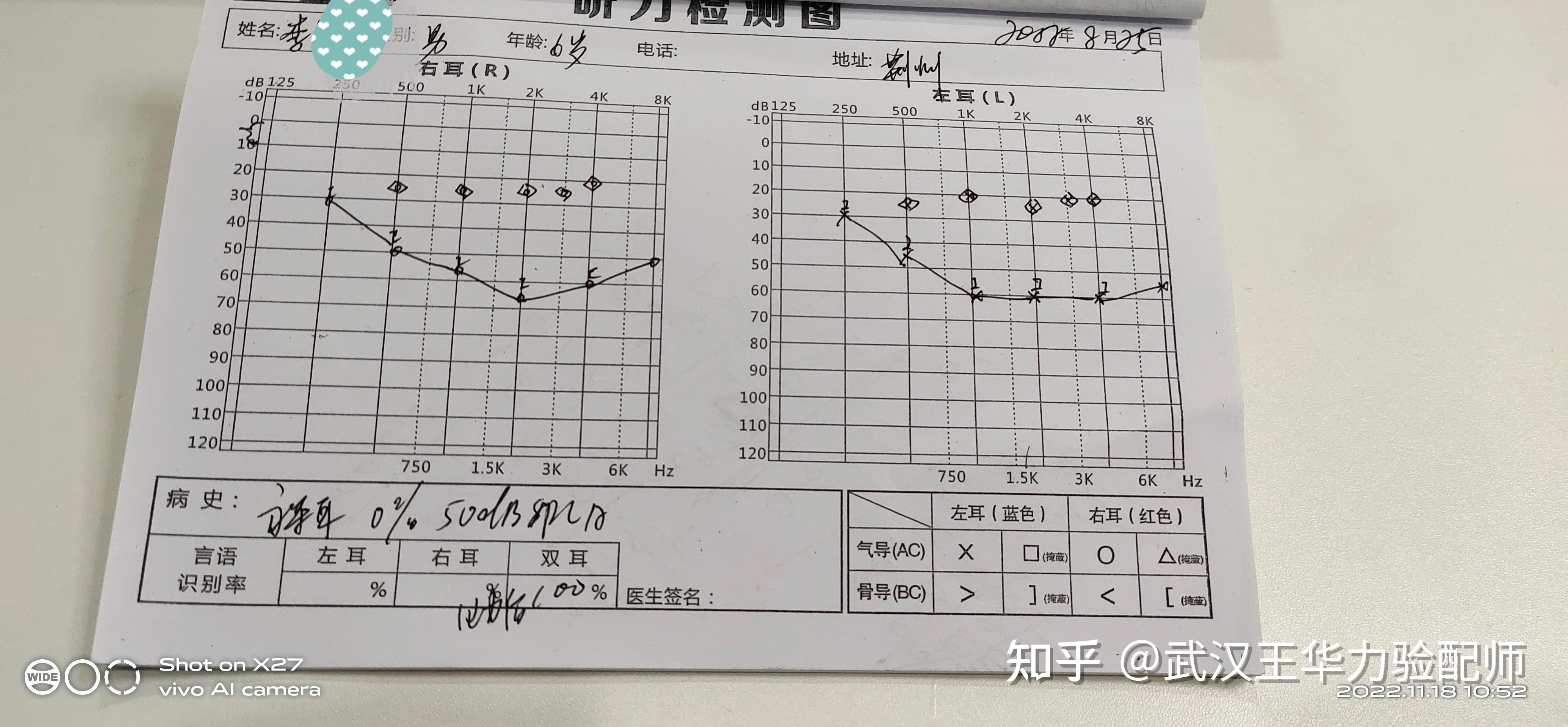 低龄儿童反应慢要警惕是听力问题 - 知乎