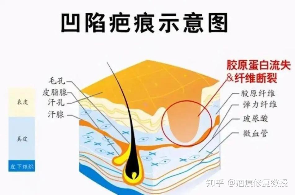 凹陷性疤痕还能长平吗?医生教你不走弯路! - 知乎