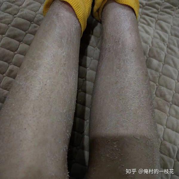 小腿鱼鳞蛇皮肤,不是简单的皮肤干燥?