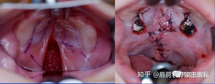 腭裂小舌分开手术后图图片