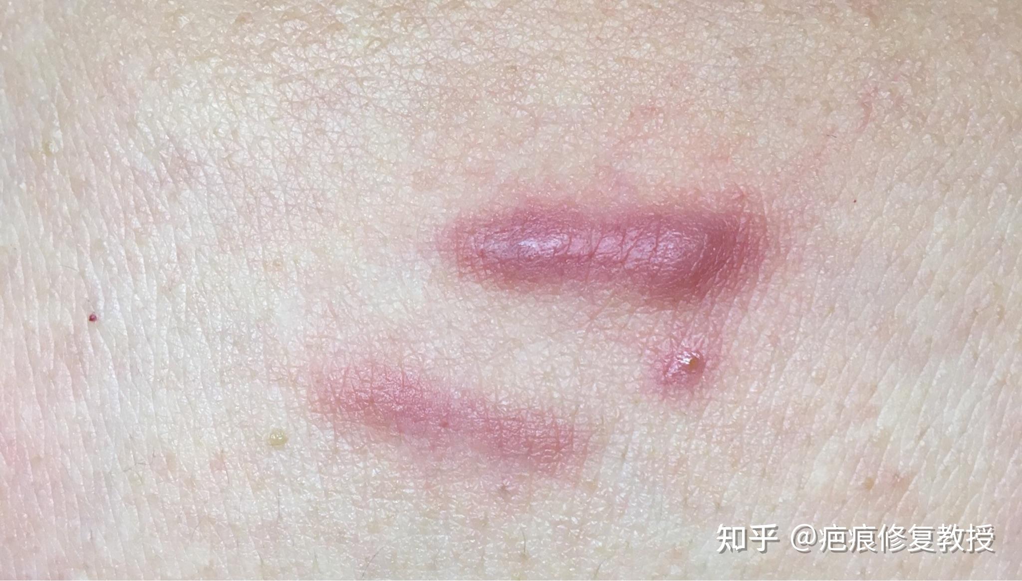 为什么会疤痕增生 为什么会疤痕增生