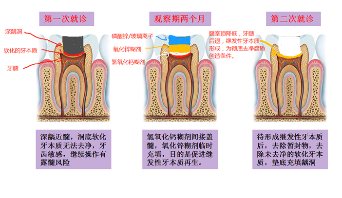 牙齿疼痛自检 - 知乎