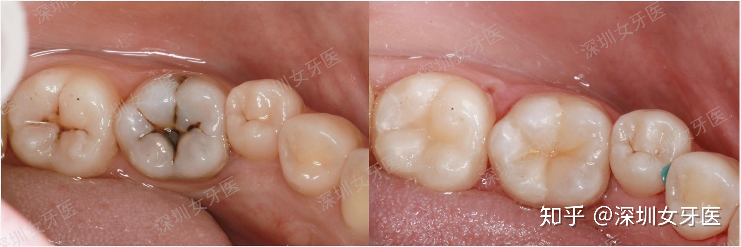 蛀牙一定會痛嗎？補牙後導致「再蛀牙」的3大原因｜悅庭牙醫診所