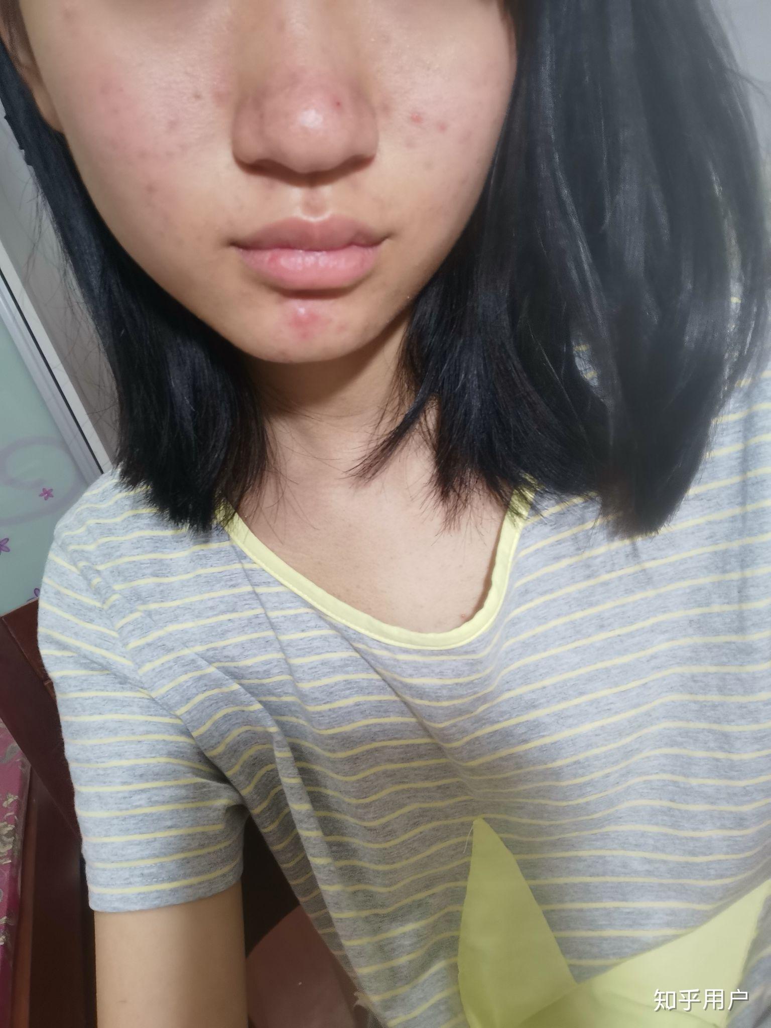 拥有宽鼻翼大鼻头是怎样一种体验? - 知乎