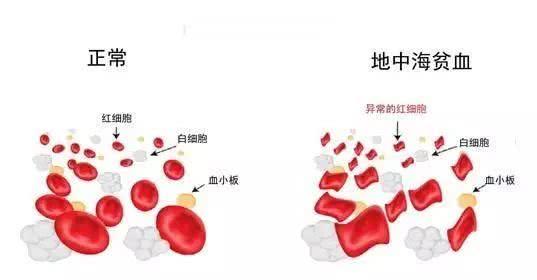 地中海貧血是什麼病可以買哪些保險