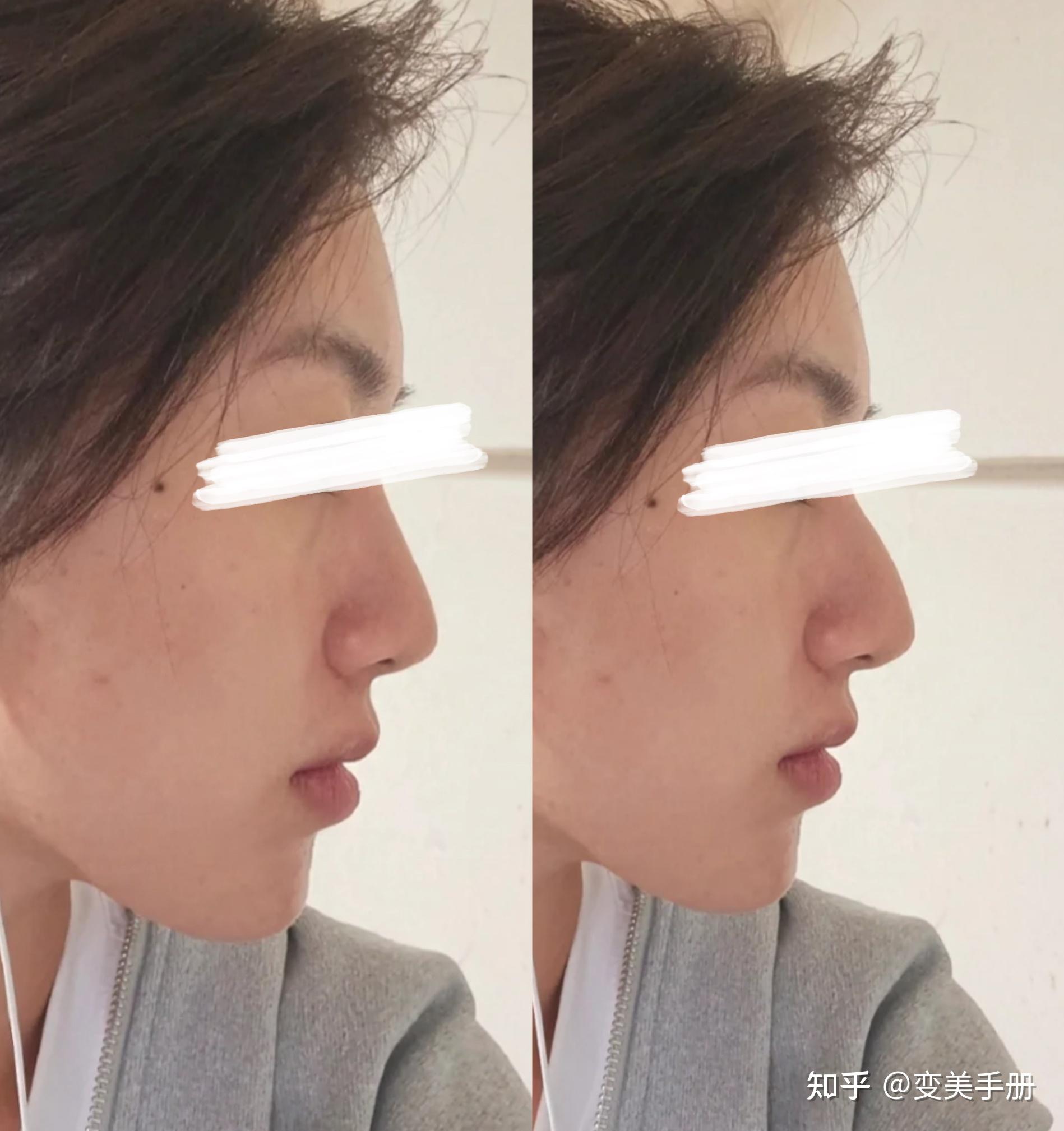 鼻整形手术中，蒜头鼻如何改善？
