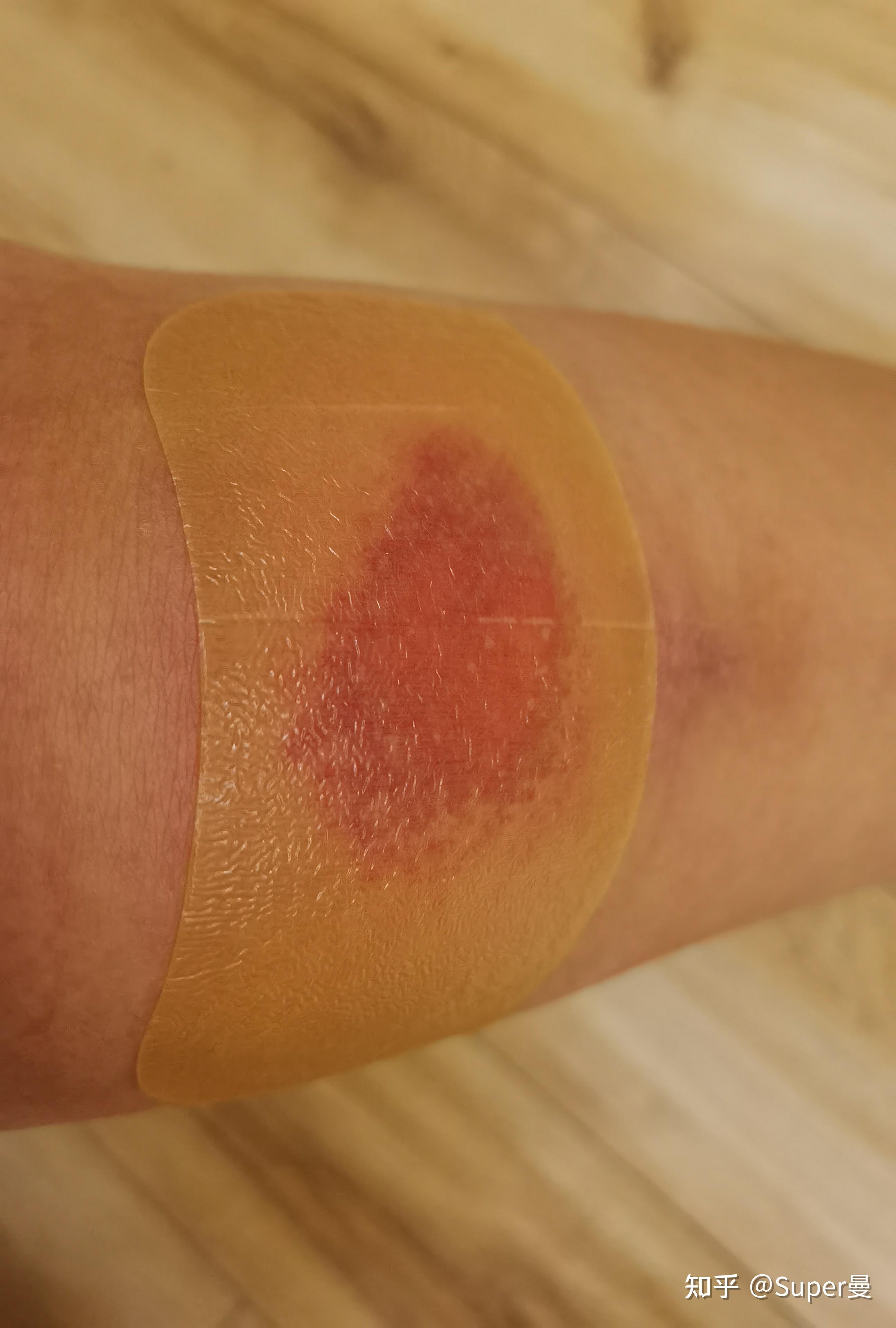 擦伤湿性愈合恢复日记