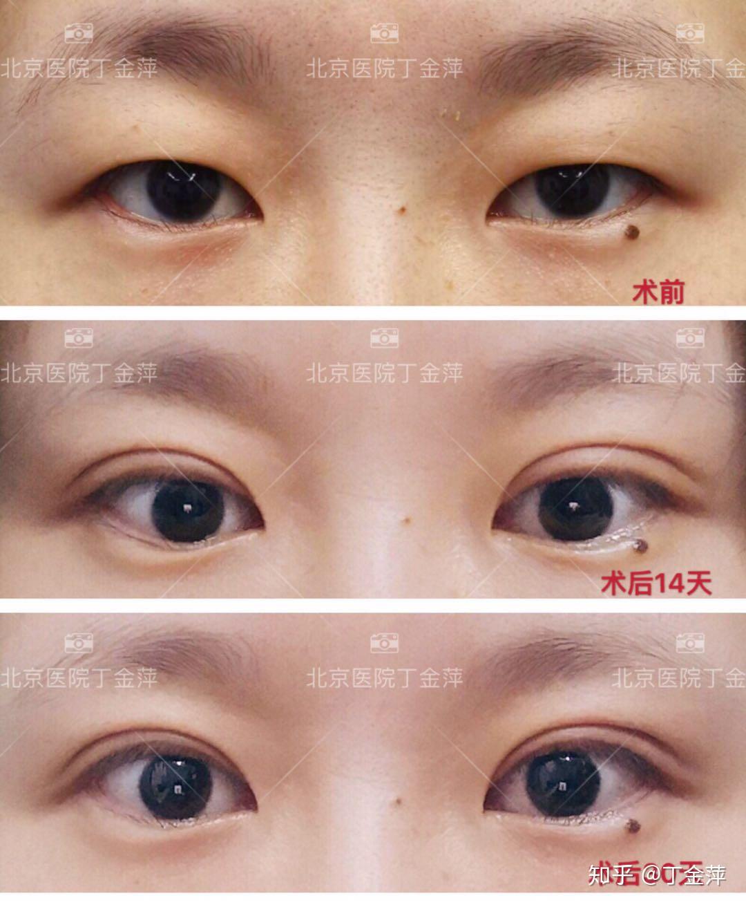 北京医院双眼皮案例分享（丁金萍）全切双眼皮+眶隔释放 - 知乎