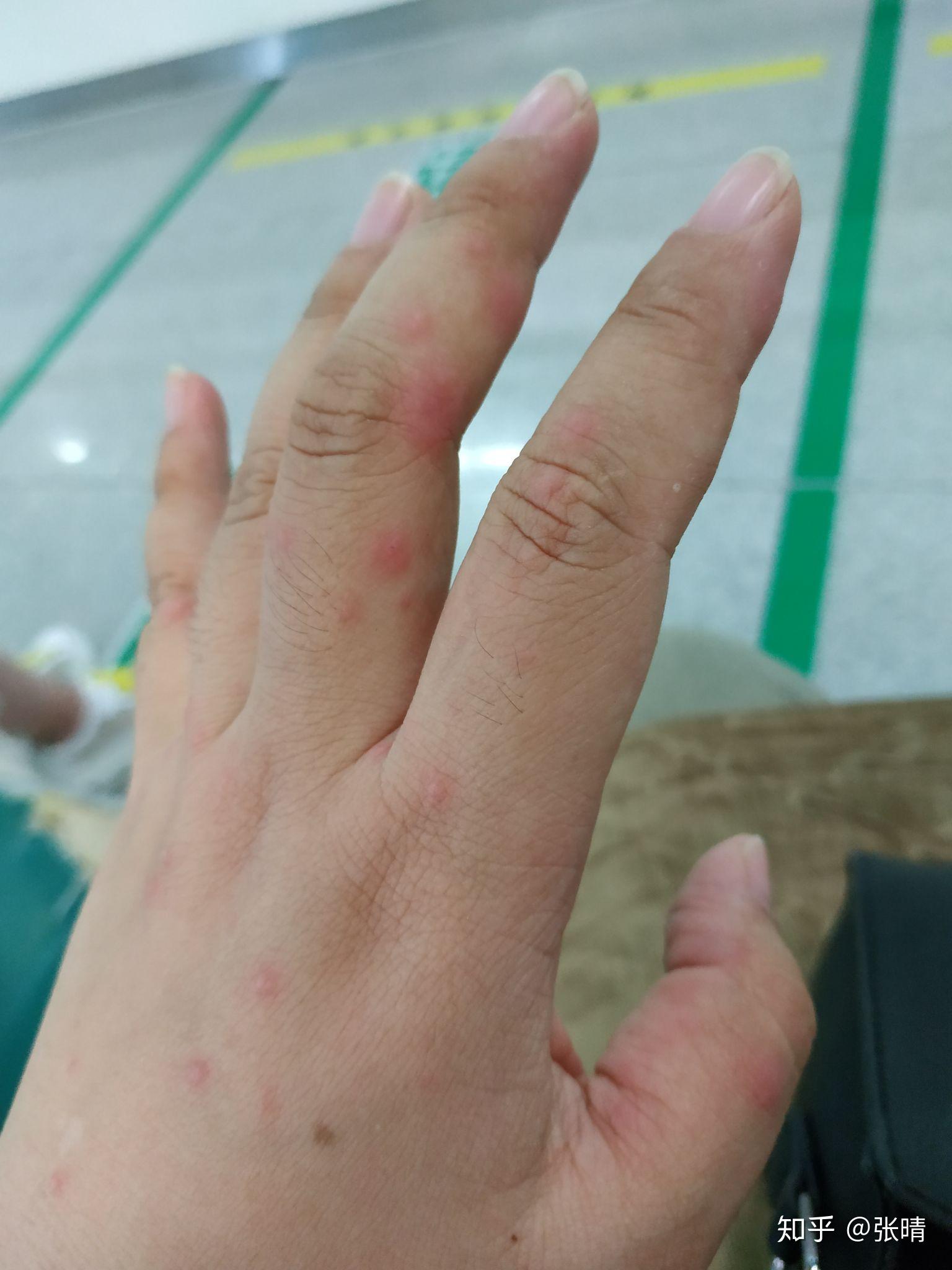 2019年多形性红斑记录