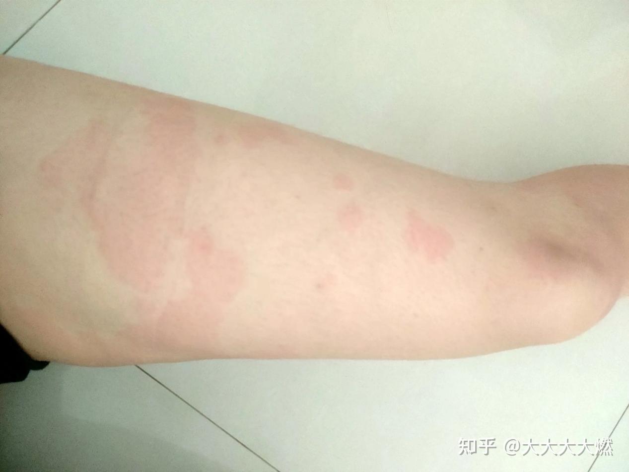 所以连我们科室都知道了,最近倒是不常见了,一问找到过敏源,是沐浴露