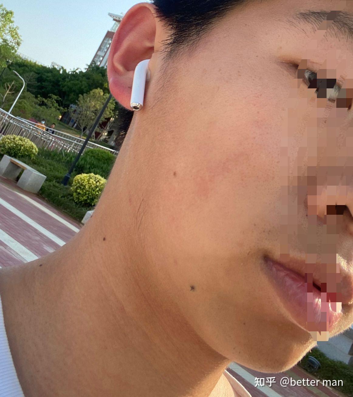 面部毛周角化 - 知乎