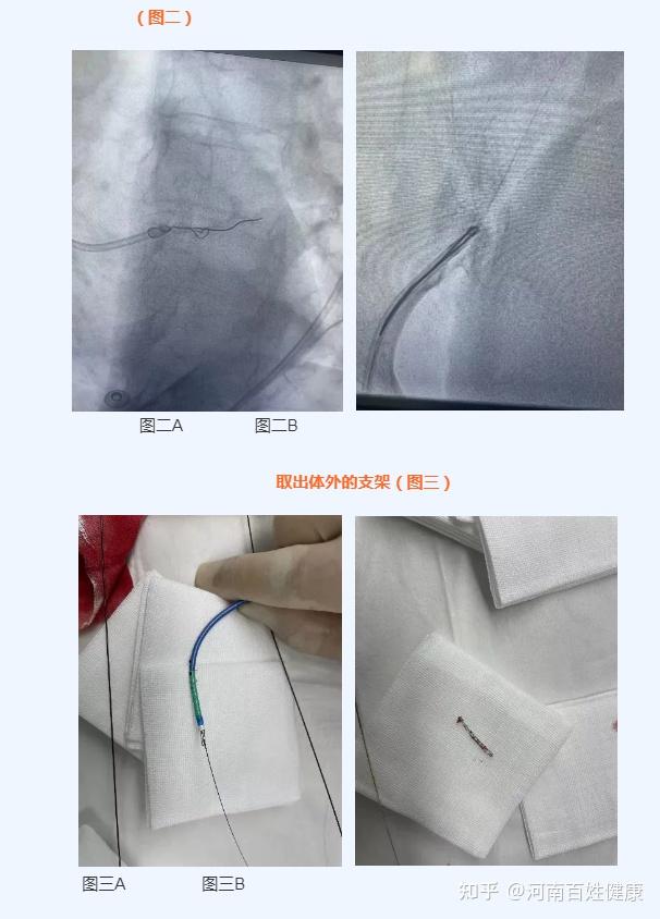 如果再次进行支架置入手术,支架脱载的风险仍然较大,于是用切割球囊