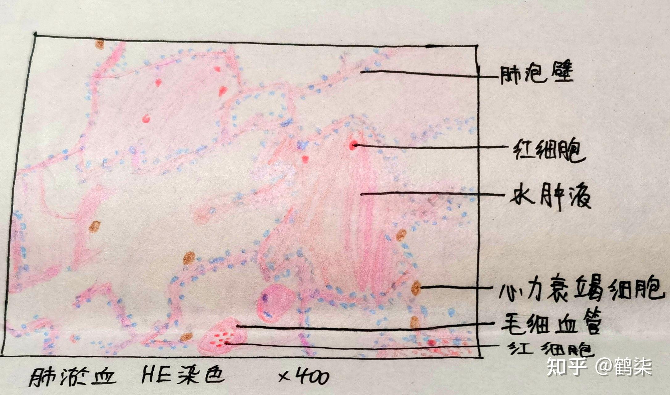 病理紅藍鉛筆繪圖