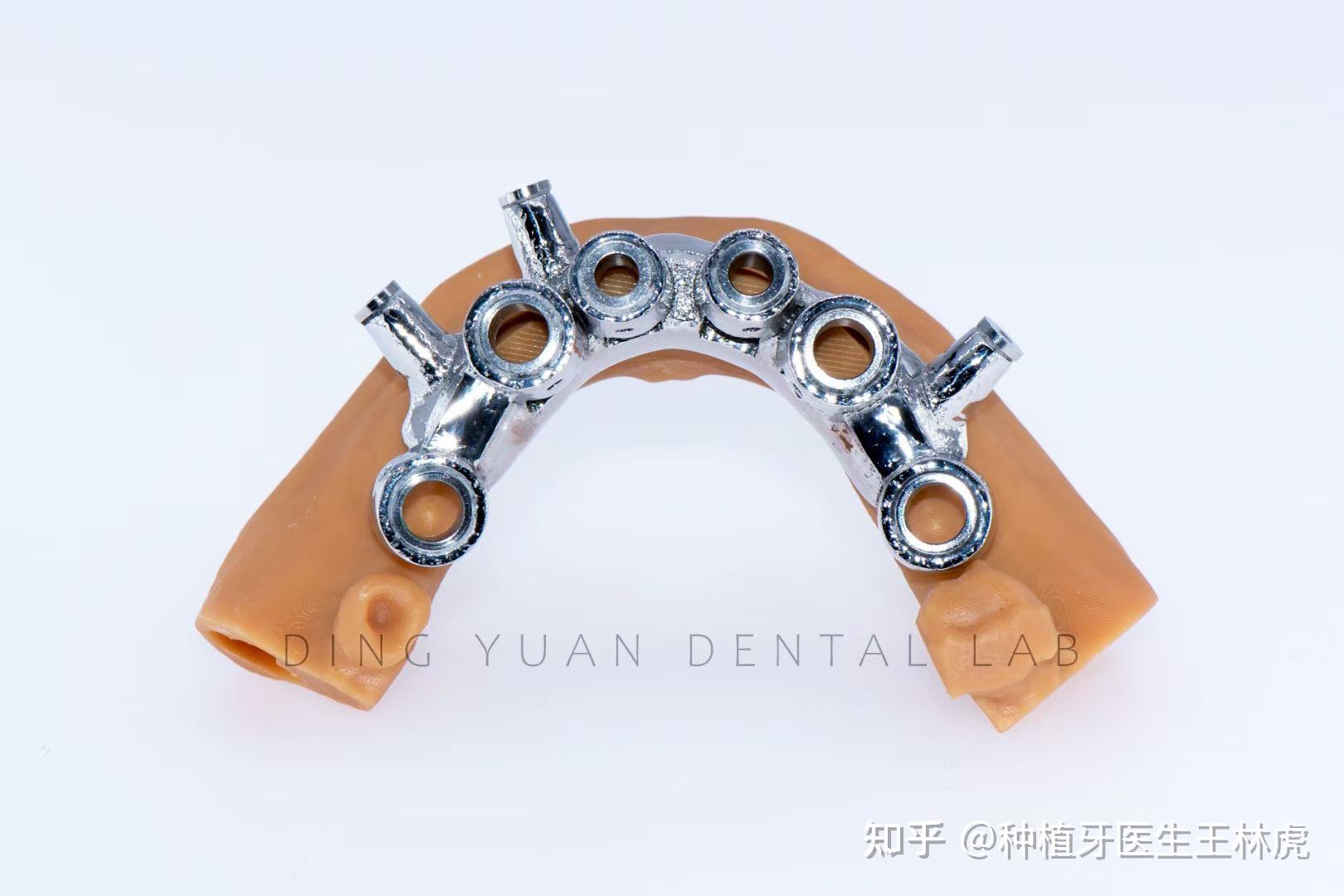 数字化导板种植