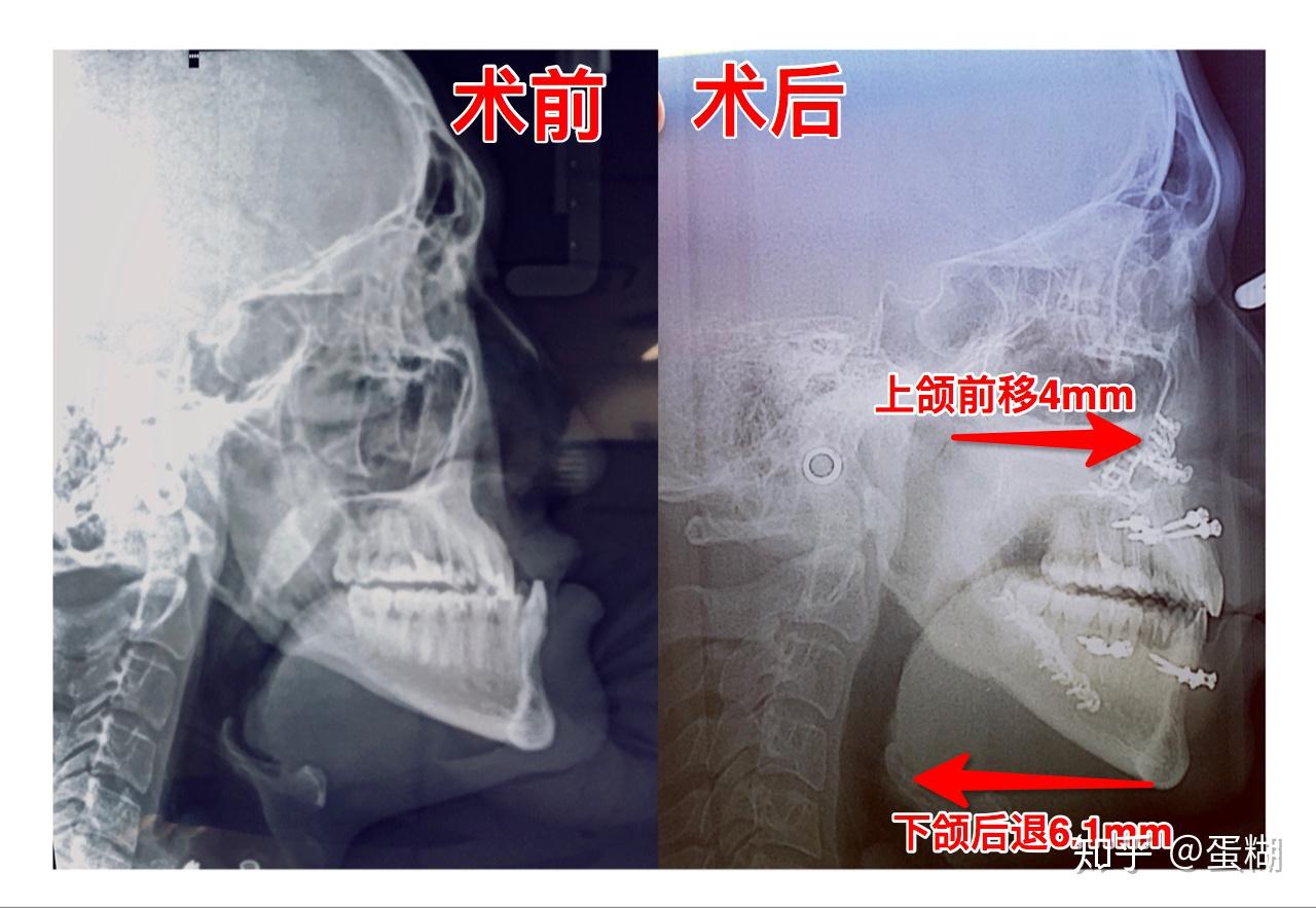 颌面骨骼综合矫治——正颌外科与面部轮廓整形的联合应用与思考