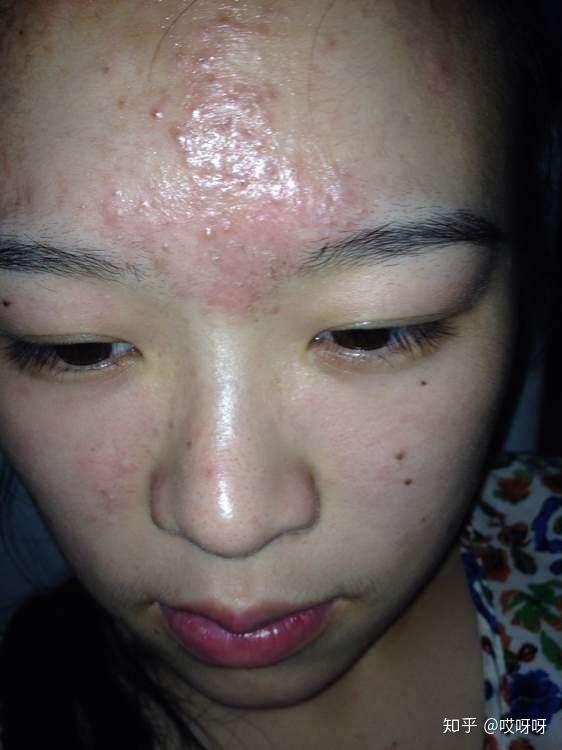 为什么刘海下面长痘痘