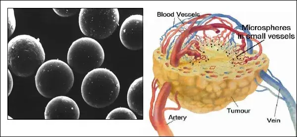 Medtech Fda批准therasphere Y 90玻璃微球 知乎