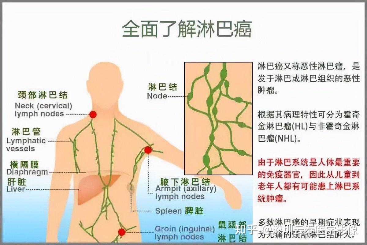 系統的惡性腫瘤,主要表現為無痛性淋巴結腫大,肝脾腫大,全身各組織