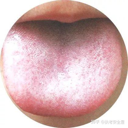 【舌诊大全】120种常见的舌苔超清彩色图谱，建议收藏！ - 知乎