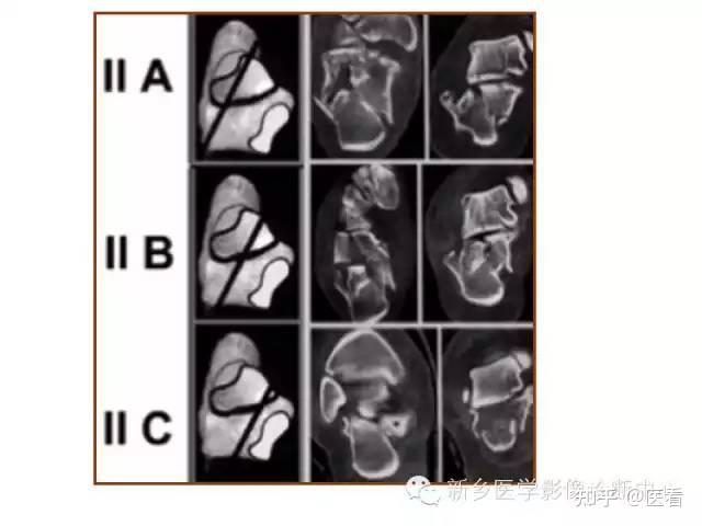【分型】跟骨骨折的分型与图解 - 知乎