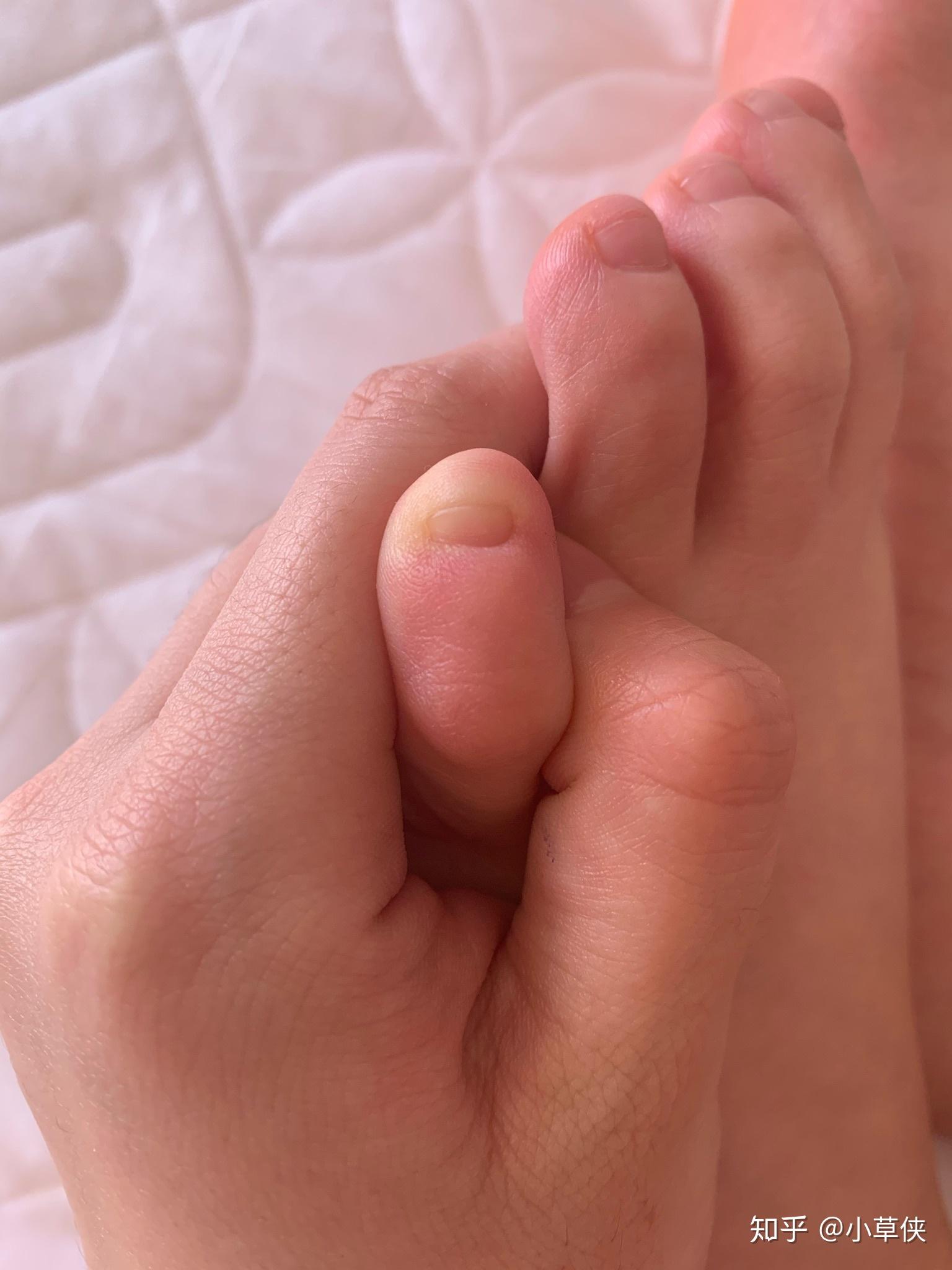 小脚趾的指甲特别难看怎么办