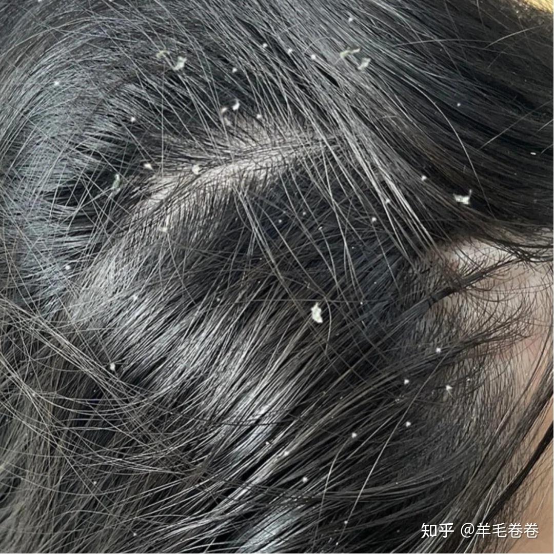 头发出油严重导致头皮屑巨巨巨多怎么办?
