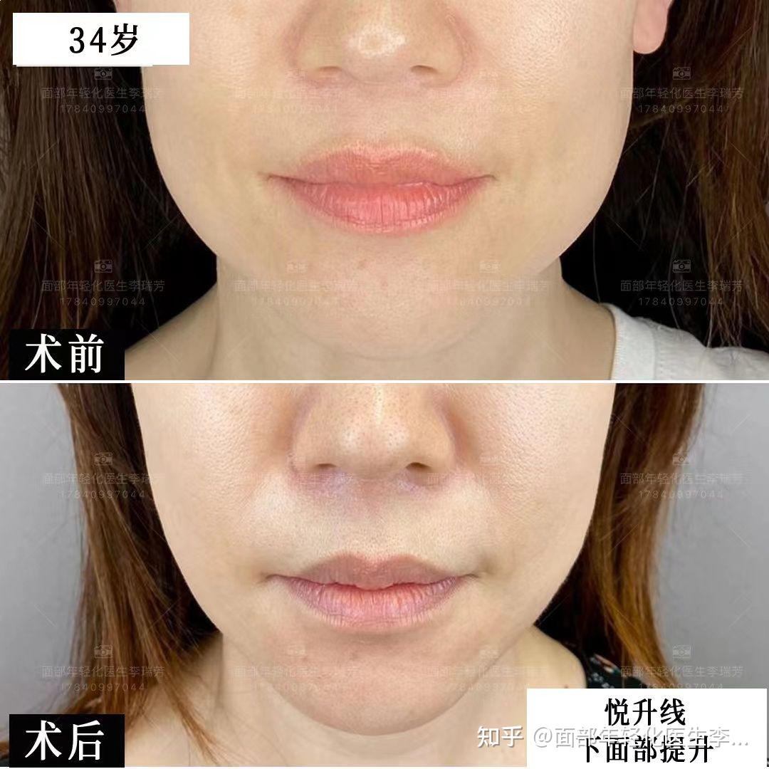 悦升线下面部提升术后两个月的效果对比整形医生李瑞芳,专注面部年轻