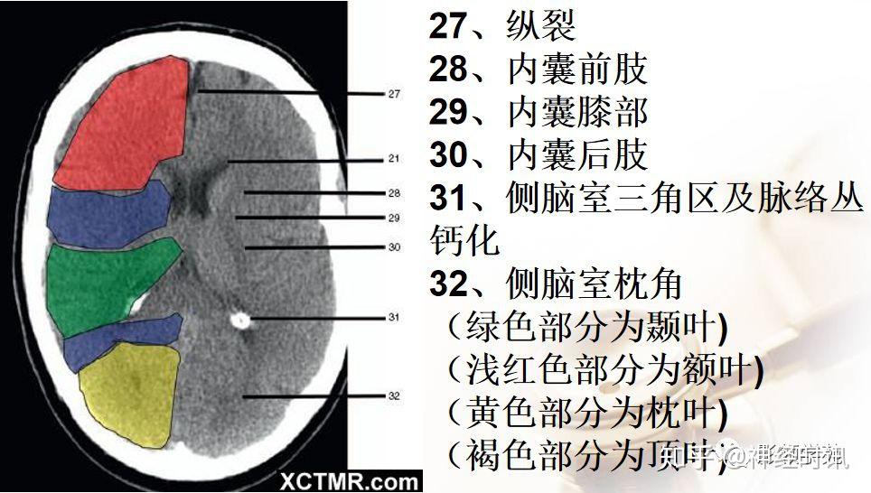 侧脑室ct解剖图片