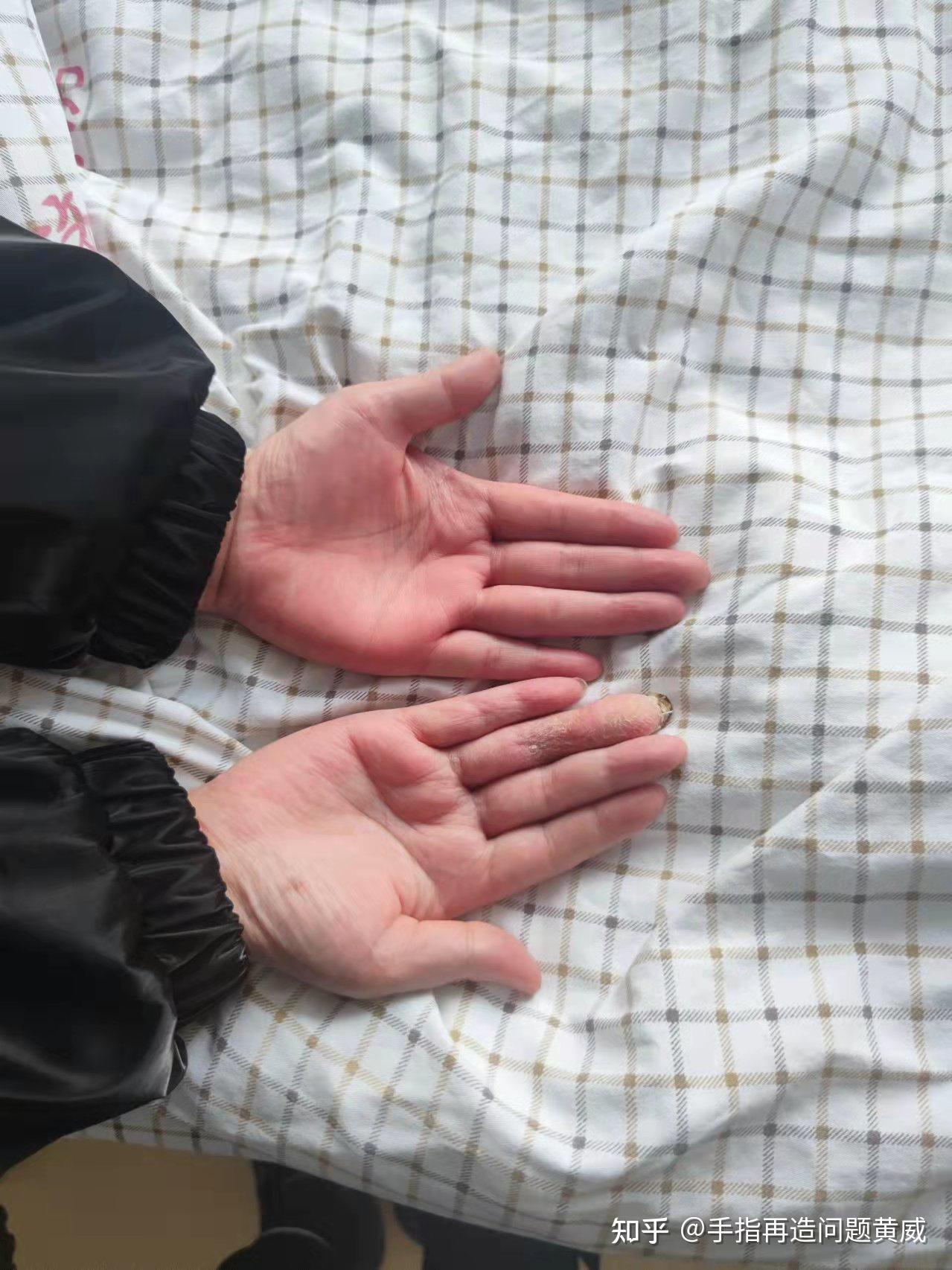 六指症手术风险大吗?什么治疗方式最可靠? - 知乎